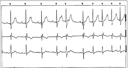 Fig. 4. First degree or 2：1 pseudo AV block. Functional AV block occurred in the setting of fast atrial rate and dramatically prolonged ventricular replorization as the P waves fell within the T wave (Patient 10)