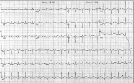 Fig. 3. Abnormal ECG change mimicking acute myocardial infarction. At intensive care unit, the patient compl- compl-ained of atypical chest pain with marked ST-T wave changes (10 mm ST segment elevation in leads V 1-6 , I, aVL and ST segment depression in 