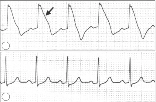 Fig. 1. Three hours into surgery a 5 mm ST segment elevation was noted on a monitoring ECG (arrow, A), which returned to baseline after 1-2 minutes (B)