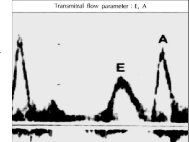 Fig. 1. Transmitral flow parameter, E：early transmitral fil- fil-ling velocity, A：late transmitral filfil-ling velocity 