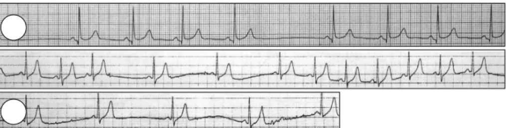 Fig. 2. Case 3：resting ECG shows intermittent sinus exit blocks (A). ECG recorded during the recovery phase of the treadmill exercise test