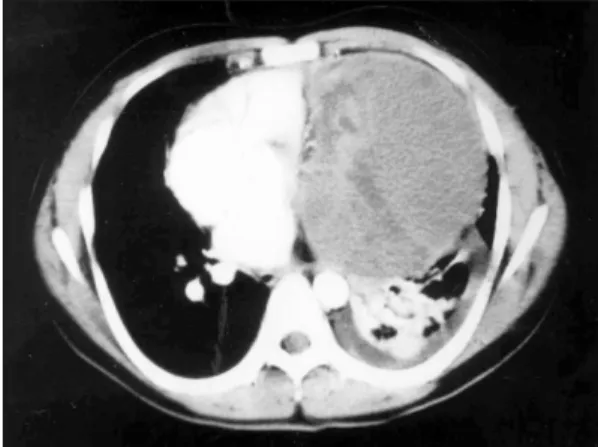 Fig. 1. Initial chest PA, marked cardiomegaly which is su- su-ggested to be a mediastinal mass or pericardial effusion