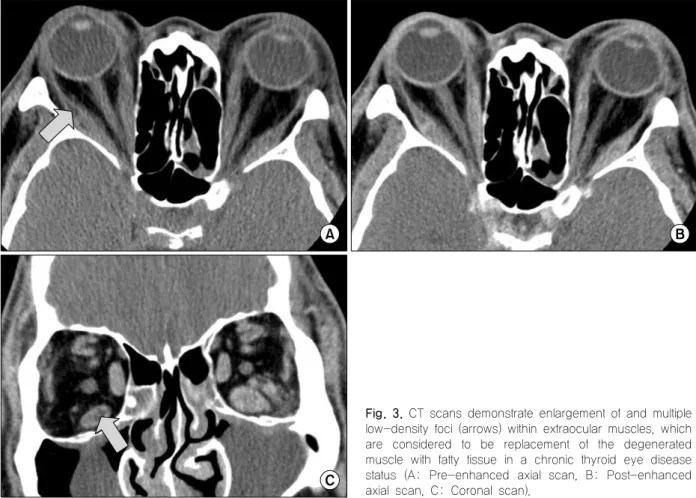 Fig.  3.  CT  scans  demonstrate  enlargement  of  and  multiple  low-density  foci  (arrows)  within  extraocular  muscles,  which are  considered  to  be  replacement  of  the  degenerated  muscle  with  fatty  tissue  in  a  chronic  thyroid  eye  disea
