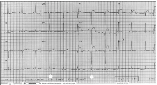 Fig. 1. Electrocardiogram showing Q wave and ST segment elevation in precordial leads V 1 -V 4 