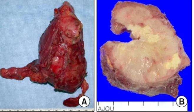 Fig.  2.  FDG-PET/CT  images  demonstrate  abnormal  intense  uptake  in  the  left  thyroid  gland  and  nodal  uptake.