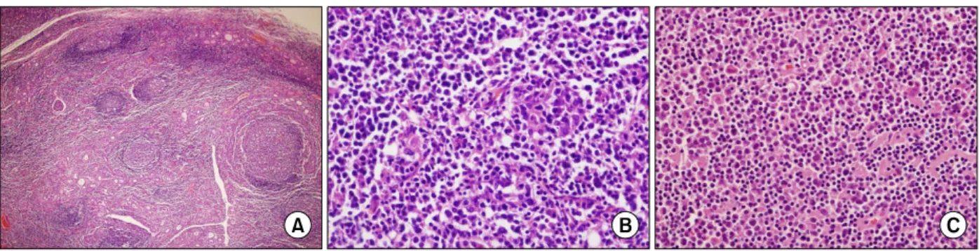 Fig.  4.  Microscopic  findings  of  the  thyroid  mass  shows  mixed  diffuse  large  B-cell  lymphoma  and  MALT  lymphoma  in  a  background  of  Hashimoto's  thyroiditis