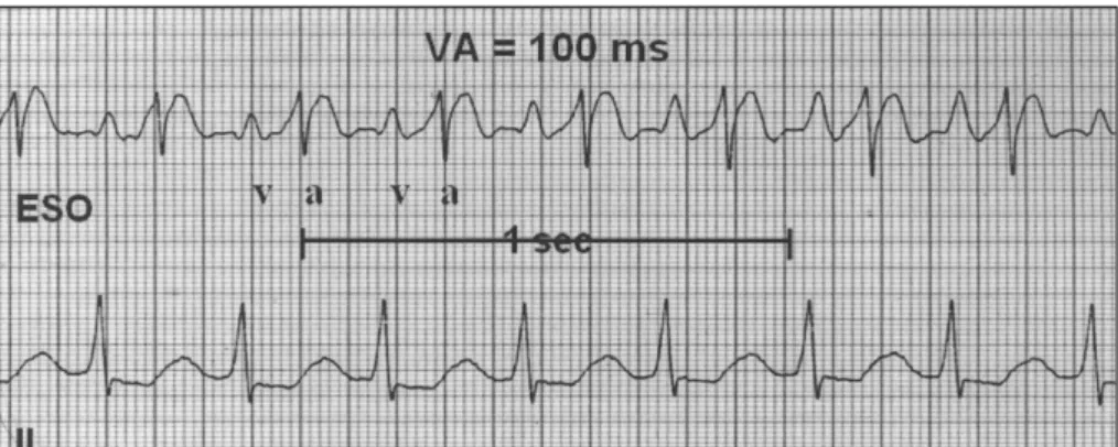 Fig. 1. Transesophageal electrocardiogram of atrioventricular reentrant tachycardia VA：ventriculoatrial interval, ESO：esophageal lead, V：ventricular deflection, A：atrial deflection