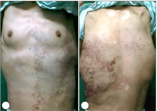 Fig. 1. There are asymptomatic, diffuse, confluent, some irregularly elevated, bright or dark purplish patches and plaques on the trunk