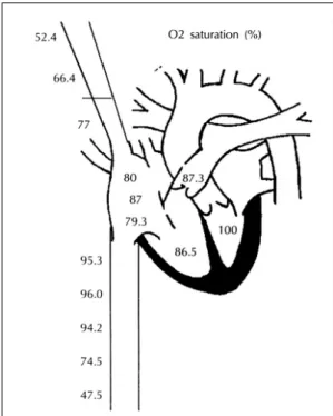 Fig. 6. In initial angiography, there is noted spinal arteriovenous malformation fed by right bronchial artery (A).