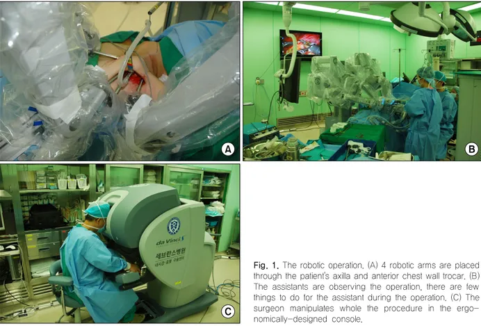 Fig. 1. The robotic operation. (A) 4 robotic arms are placed through the patient's axilla and anterior chest wall trocar