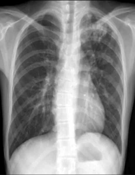 Fig.  2.  Chest  PA  on  admission  day  showed  patch-like  opacity  of  Lt.  upper  lobe.
