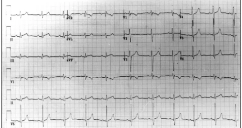 Fig. 1. Electrocardiogram showed sinus rh- rh-ythm of 90 per minute, ST segment elevation  and Q wave in lead II, III and aV F 