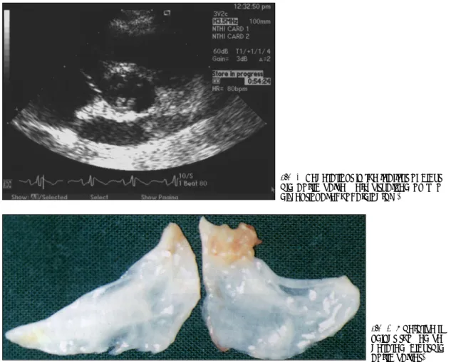 Fig. 4. Vegetations in the leaflets of bicus- bicus-pid aortic valve were visualized on  two-dimensional echocardiogram