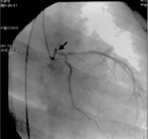 Fig. 2. A：Two-dimensional echocardiogram shows an ostial stenosis and acute angle takeoff of the left main coronary artery