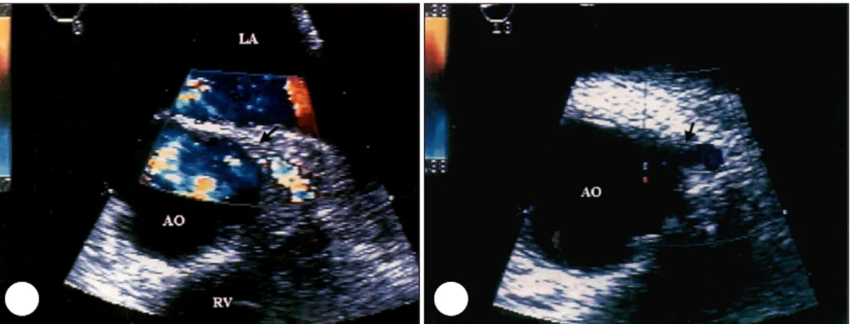 Fig. 3. Two-dimensional color flow Doppler images of short axis view through the aortic valve