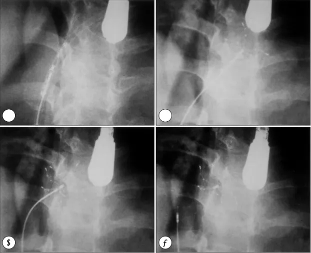Fig. 1. The atrial septal defect (ASD) closure procedure with CardioSEAL TM  device. A：The device is fully compr- compr-essed within the sheath