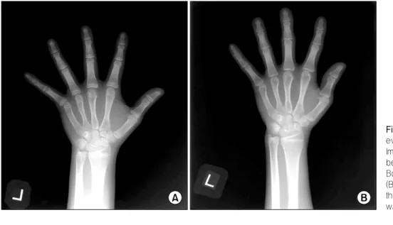 Fig. 1. Left hand PA view for evaluation  of  bone  age.  (A)  Image at the time of initial visit  before  thyroxine  therapy