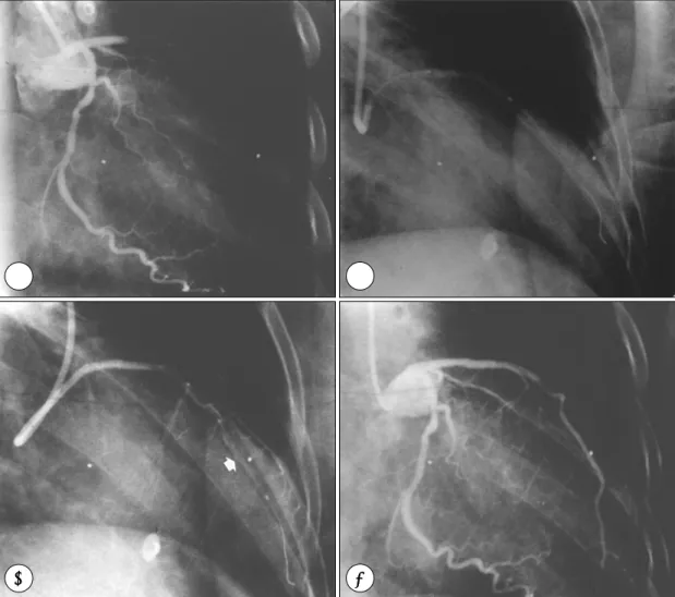 Fig. 1. A：Left coronary angiogram showed total occlusion of proximal left anterior descending artery (LAD)