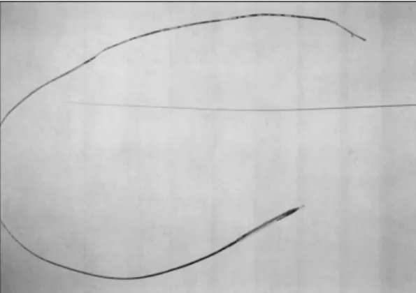 Fig. 2. Photograph showed disconnected steel hypo- hypo-dermic tube shaft and plastic segment of balloon