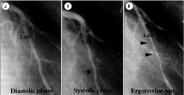 Table 3. Angiographic data of myocardial bridges  Diameter  Stenosis rate* 
