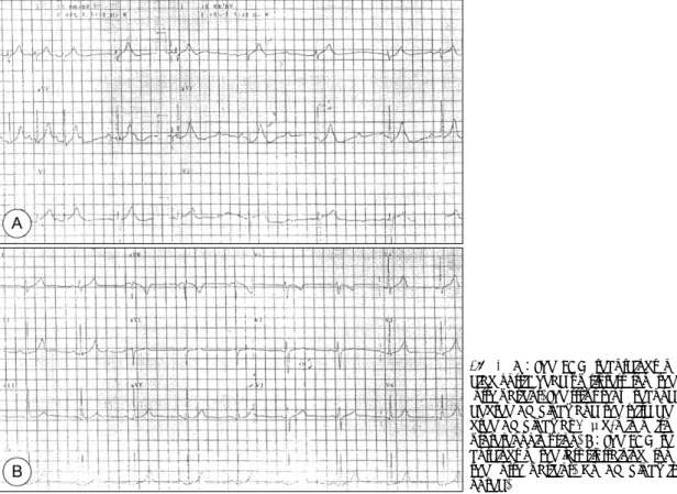 Fig. 4. A：The ECG recordings of  diag-nostic head up tilt test from the  forth patient