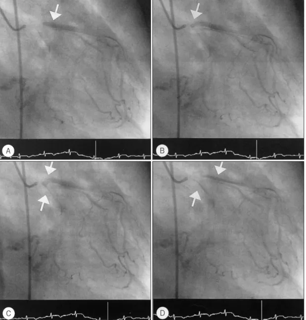 Fig. 3. Left coronary angiography：ECG indicates that Panel A, B, C, D is sequencial, arrows indicate retrograde flow from LAD to LCX