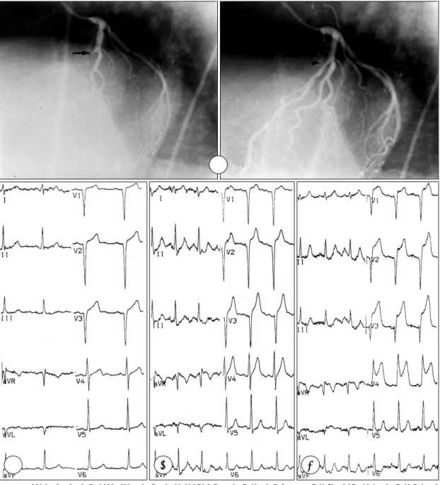 Fig. 2. A typical case of vasospastic angina patient showing different exercise ECG results by the two different modes of treadmill exercise
