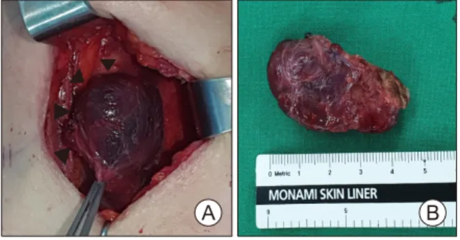 Fig. 4.  Gross  photo  of  specimen.  (A)  Exposed  left  side  of  thyroid  tissue  (arrowheads)