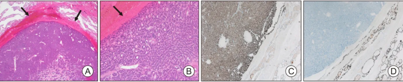 Fig. 5.  Histopathologic  findings  of  left  thyroid  gland.  Microscopic  findings  show  well-encapsulated  parathyroid  adenoma inside  the  normal  thyroid  tissue