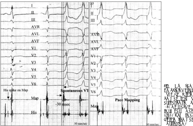 Fig. 1. One exam- exam-ple of failed  proc-edure. The V spike  on Map showed  activation time of  -30 msec and  pe-rfect pace map  (Rt.)