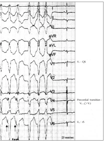 Fig. 5. An example of failed proced- proced-ure showed QS in V 1  and unusual rS  pattern in V 6 