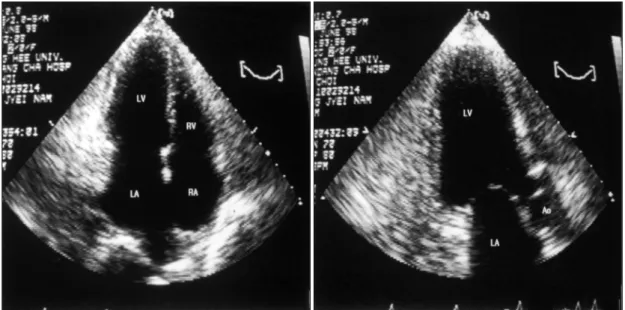 Fig. 1. Twelve lead ECG revealed atrial flutter with 4：1 conduction. 