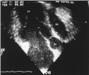 Fig. 5. TEE revealed spontaneous echo contrast (SEC) in left atrium without structural abnormality of mitral leaflets
