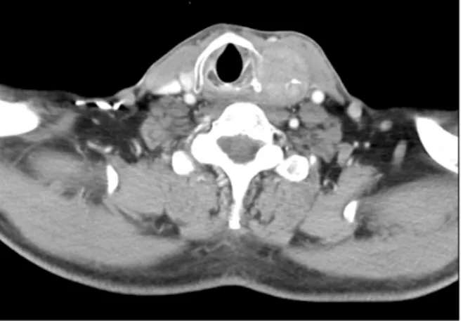 Fig. 2. Pathological appearance of the tumor shows the thyroid gland infiltrated by poorly differentiated squamous cell carcinoma (hematoxylin  and  eosin;  original  magnification,  40×  (A),  100×  (B)).
