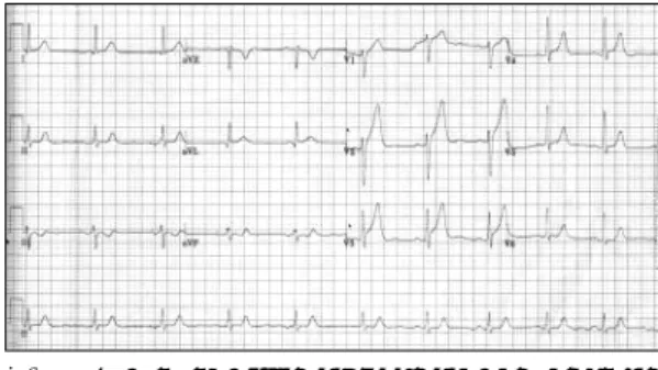 Fig. 2. ECG taken after intravenous isosorbide dinitrate  infusion shows no pathologic ST-T changes in  precord-ial and limb leads