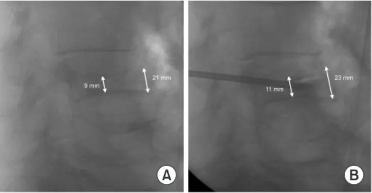 Fig. 2. The lateral image of C-arm fluoroscopy. There is the phenom- phenom-enon of spontaneous recovery of the collapsed vertebral body