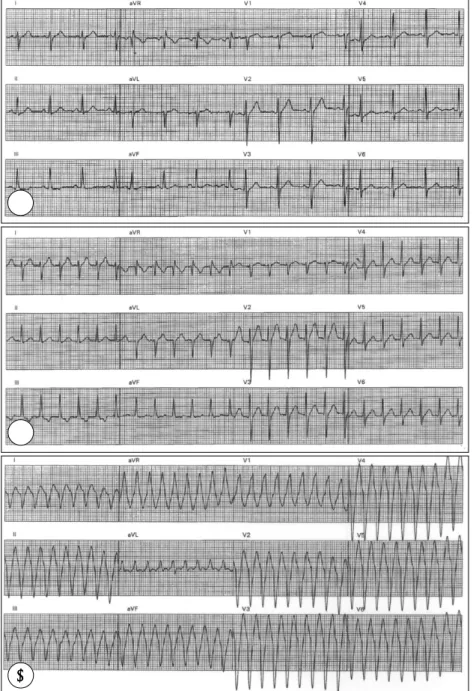 Fig. 1. Standard surface 12 lead ECGs. During resting state (A) surface ECG showed regular sinus rhythm with left posterior hemiblock