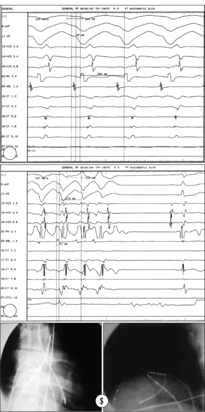 Fig. 3. RF Ablation of VT. A：intracardiac recording during VT. The earliest “v” activation site was determined