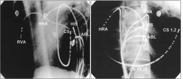 Fig. 6. Surface electrocardiogram (I, V 1 ) and intracardiac recordings during sinus rhythm