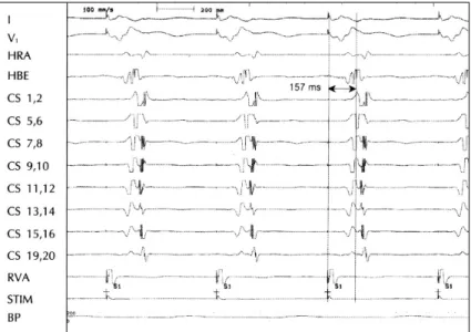 Fig. 7. Surface electrocardiogram (I, V 1 ) and intracardiac recordings during AVNRT induced by single extra-atrial stimuli