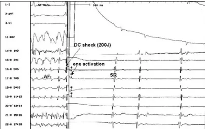 Fig. 2. Activation pattern following successful DC cardioversion：one activation (marked by*) immediately after shock preceded normal sinus rhythm (n=13)