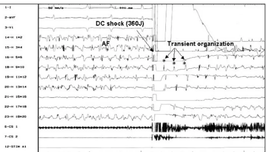Fig. 6. Activation pattern following unsuccessful DC cardioversion：transient organization (marked by*) wave no- no-ted before reverno-ted to AF (n=5)