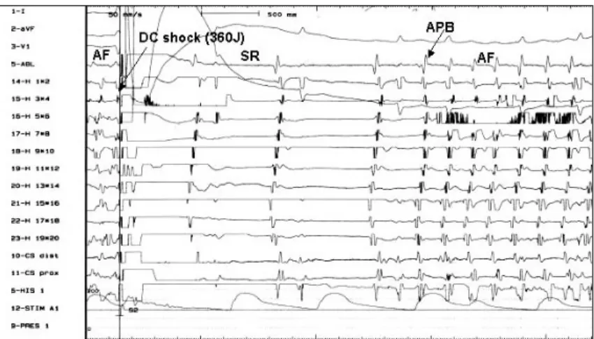 Fig. 8. Mean energy level required for cardioversion. A.