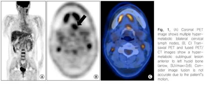 Fig.  1.  (A)  Coronal  PET  image shows multiple  hyper-metabolic  bilateral  cervical  lymph  nodes