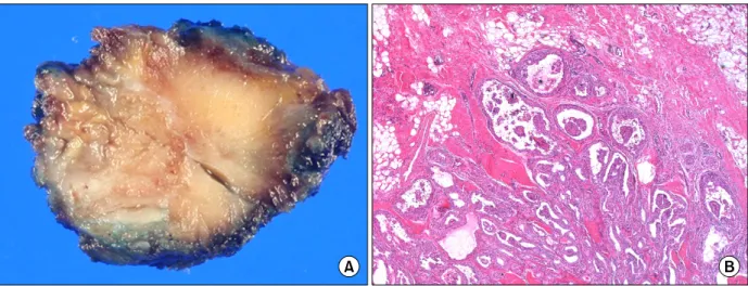 Fig.  3.  (A)  Gross  specimen  of  a  dissected  ectopic  sublingual  mass.  The  mass  is  purely  solid,  ill  demarcated,  white  to  yellow tan and firm (size, 2.0×1.0 cm)