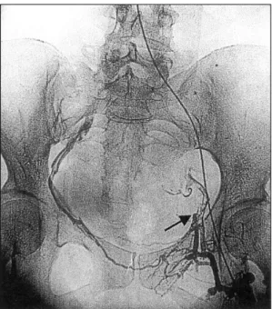 Fig. 1. Digital subtraction angiography (DSA) findings on  admission. There was a complete obstruction (arrow) of  left common femoral vein, external iliac vein and  com-mon iliac vein and venous blood was drained to the  in-ferior vena cava through collat