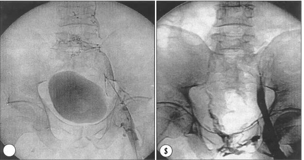 Fig. 4. Follow-up DSA after 3 days infusion of urokinase and heparin showed still remained thrombi and obstructive lesions at the left iliac vein (arrow) (A)