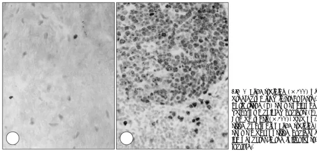 Fig. 7. Ki-67 staining (×400) of  atherectomized in-stent  reste-notic tissue (A) shows only one  dark-brown colored nucleus
