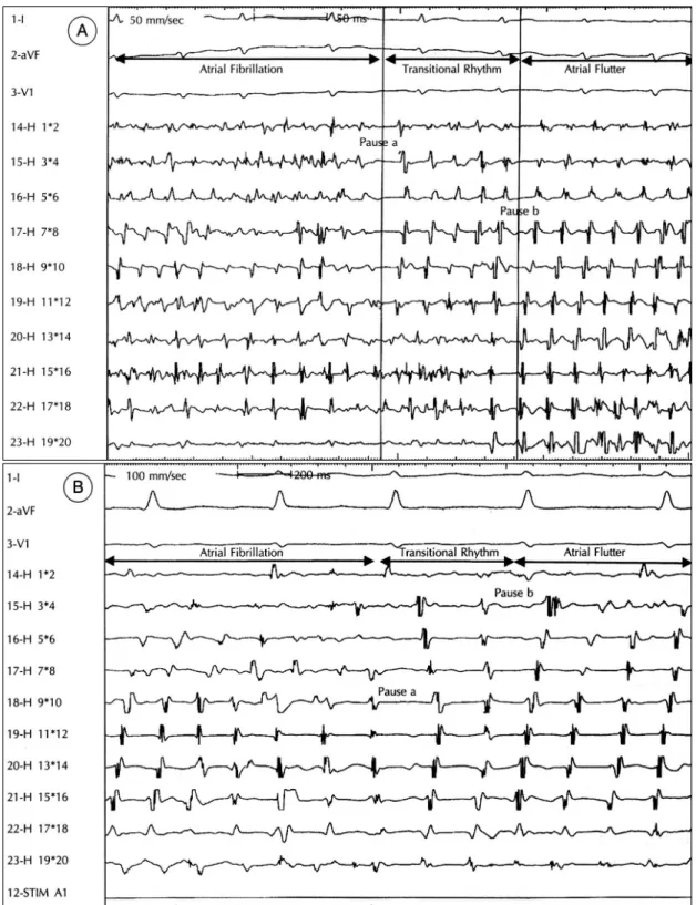 Fig. 2. A typical sequence of event in the conversion of atrial fibrillation to atrial flutter