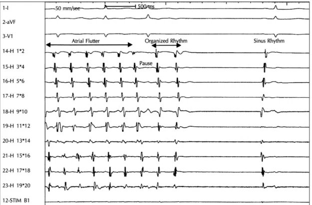 Fig. 4. One example showing atrial flutter converted to normal sinus rhythm preceded by a pause and the ch- ch-ange in activation sequence